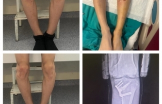 Boyabat Devlet Hastanesi’nde parantez bacak ameliyatı yapıldı